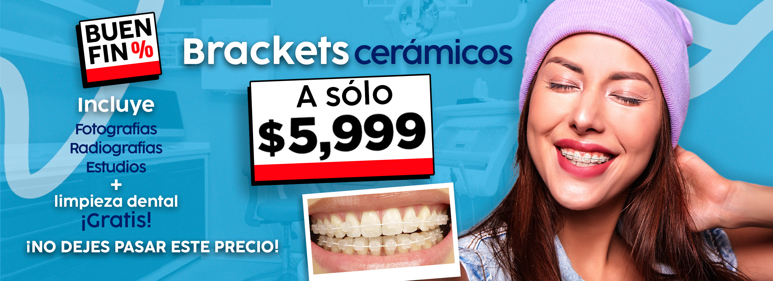 Brackets ceramicos Buen fin Hero Dentric