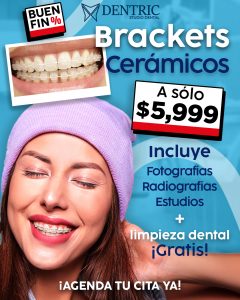 Brackets-ceramicos-Buen-fin-Pagina-Dentric_02