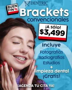 Brackets-convencionales-Buen-fin-Pagina-Dentric_02