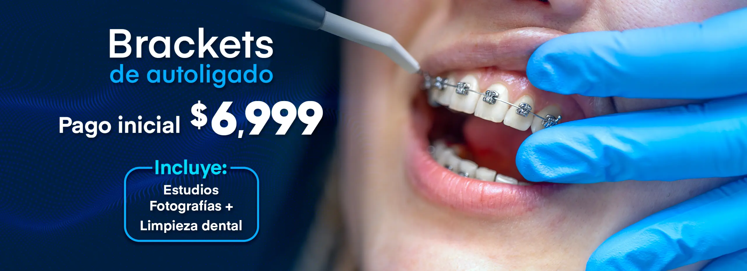 brackets_autoligados